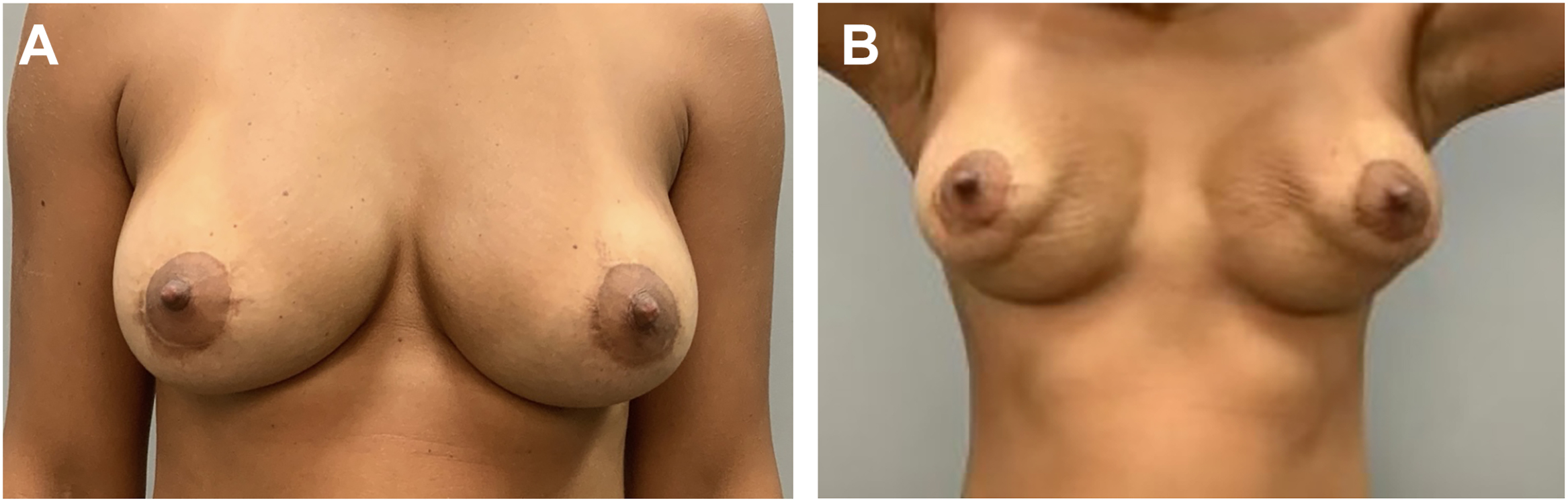 A pair of frontal views of a woman’s chest illustrates before and after changes following implant removal.