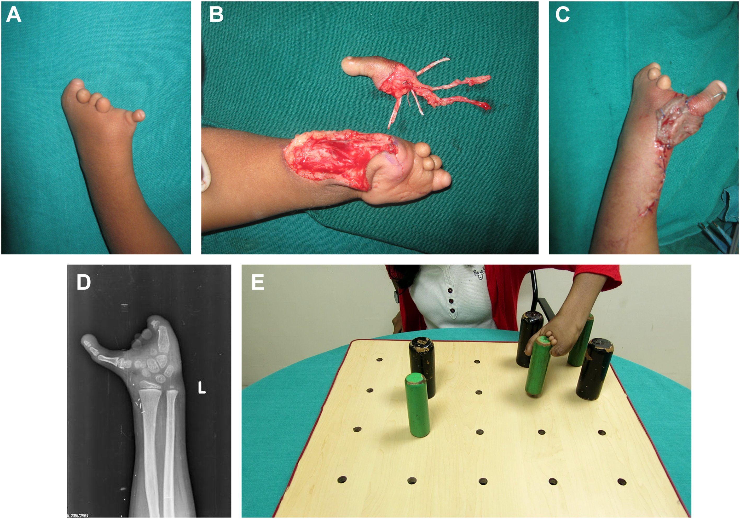Five panels depict a child with constriction ring syndrome and absent digits, reconstructed with second toe transfer as thumb, enabling grip and pinch function.