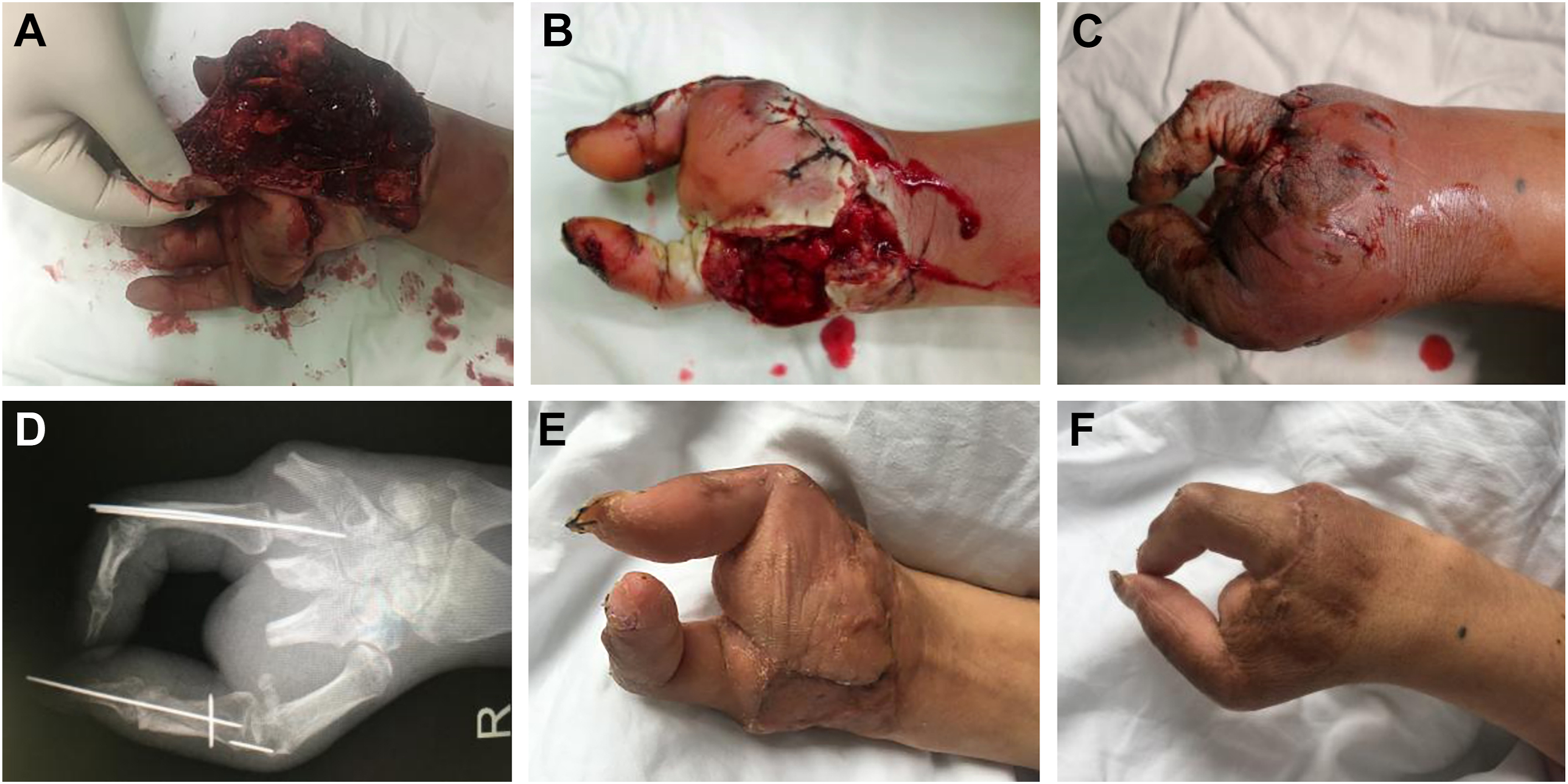 A series of six photos show a severe crushed hand injury with open wounds, X-ray of fractures, and later recovery showing healed but deformed hand.