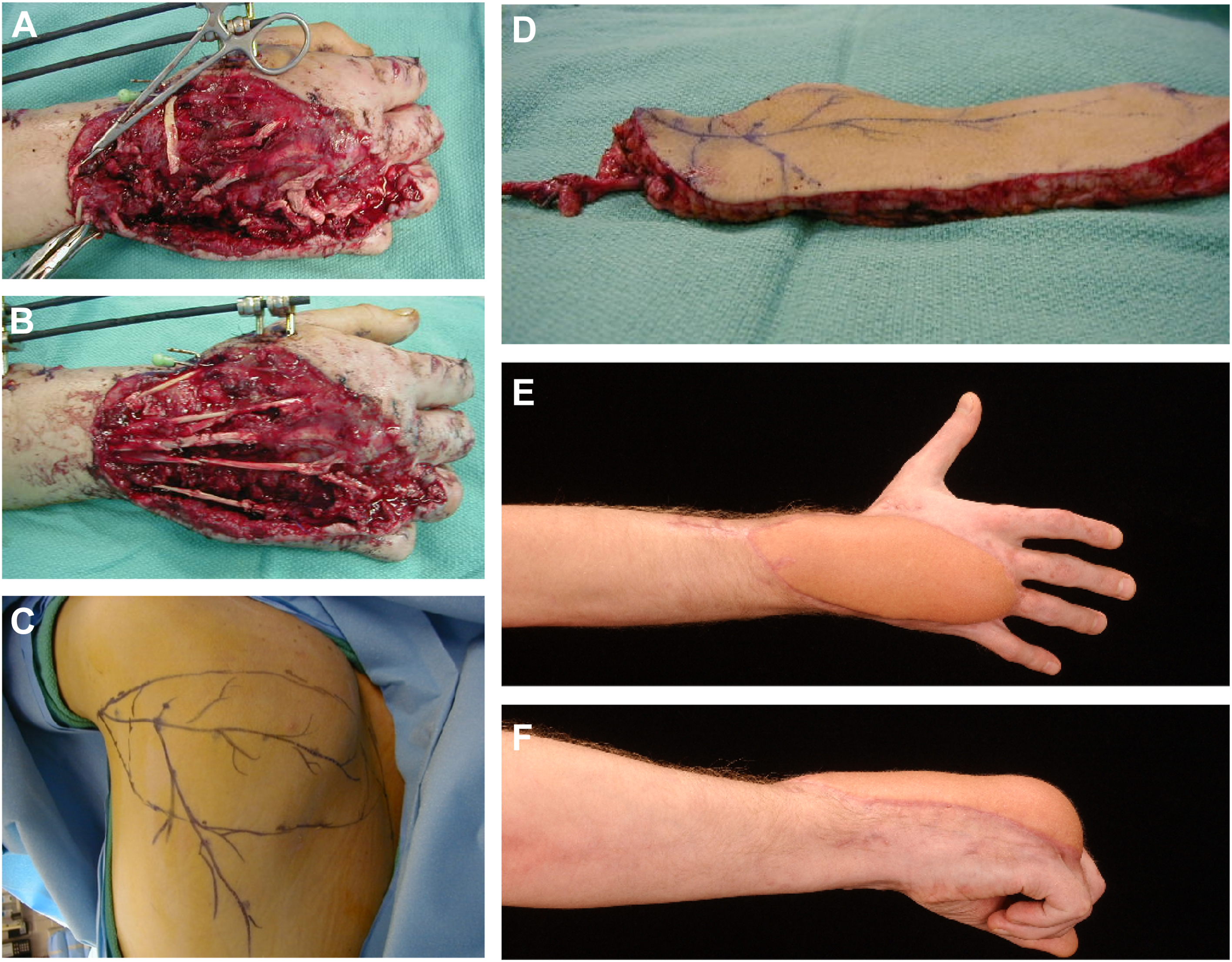Six surgical photos show the stages of hand reconstruction: initial injury, flap design on the upper arm, transfer of the soft tissue flap, and the final appearance of the reconstructed hand.