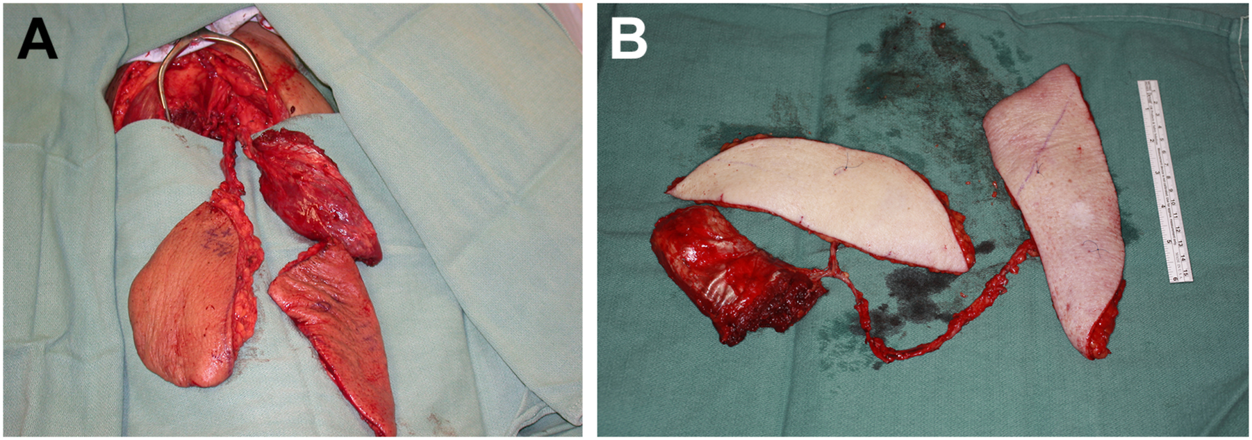 Two medical photos show a harvested surgical flap consisting of skin and muscle.