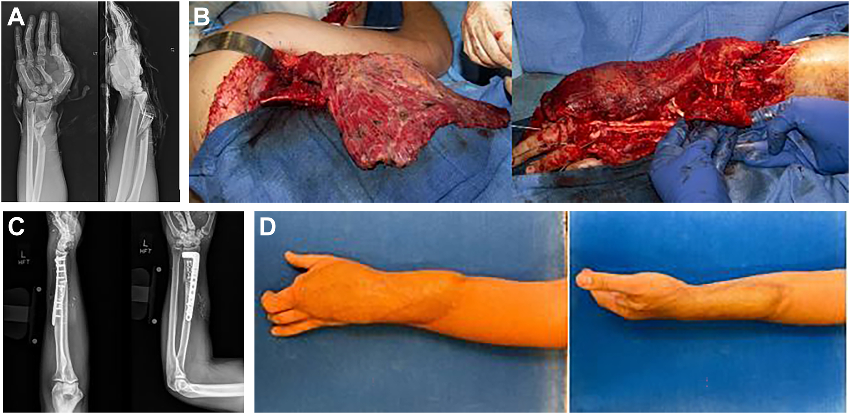 A series shows severe forearm injury with bone loss, surgical reconstruction using grafts, and a healed arm with restored structure and function.