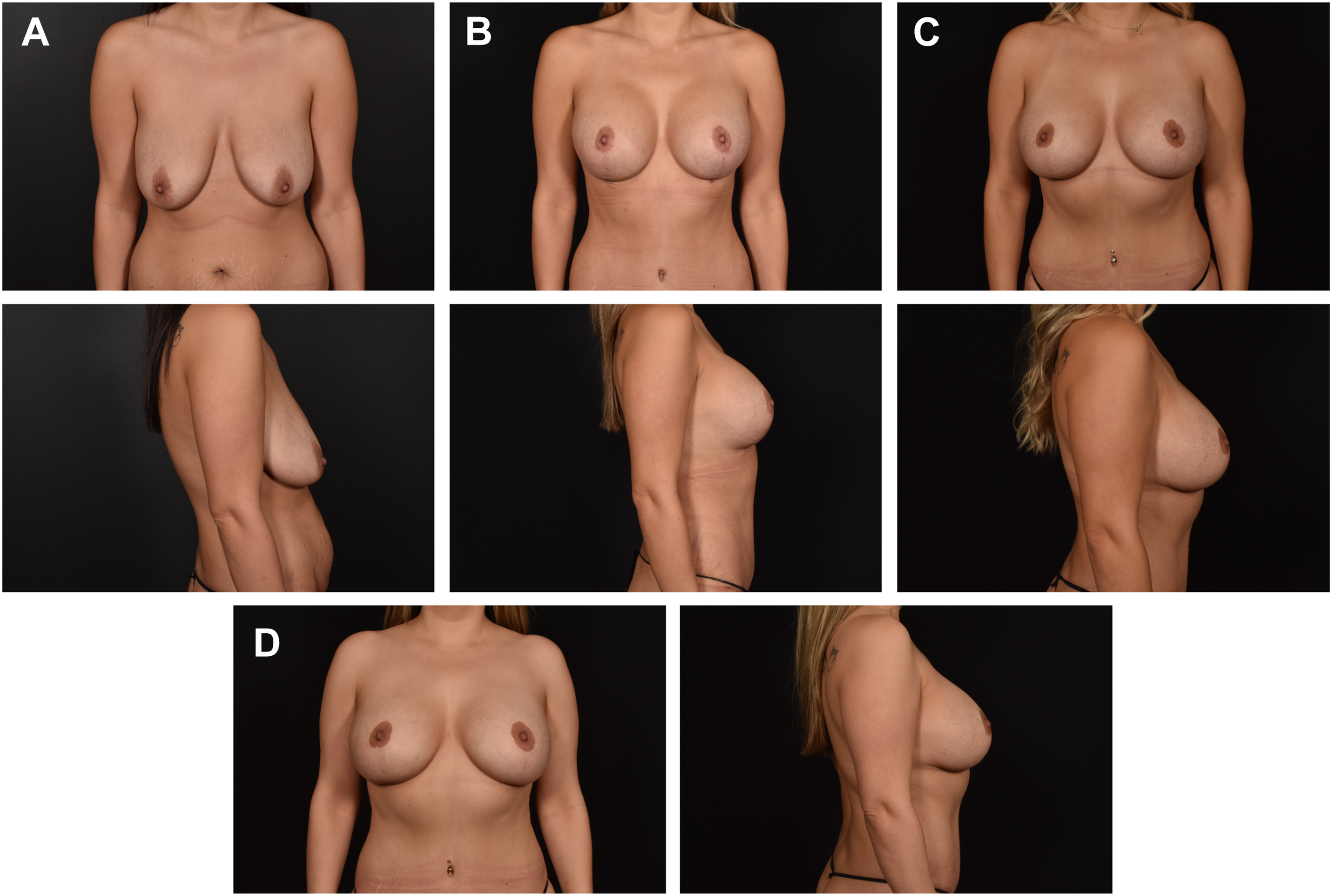 A set of photographs shows a woman before and after breast augmentation with mastopexy over several years in front and side views.