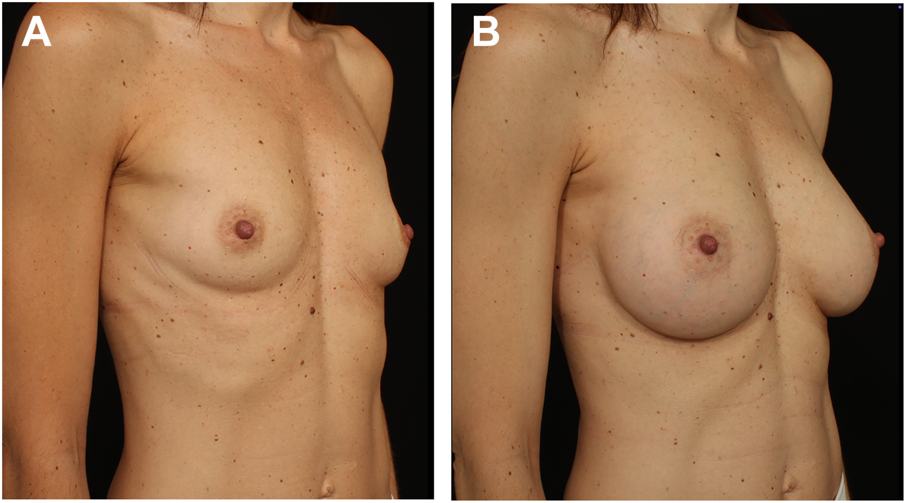 A pair of photographs shows a woman before and after breast augmentation in a three quarter view.