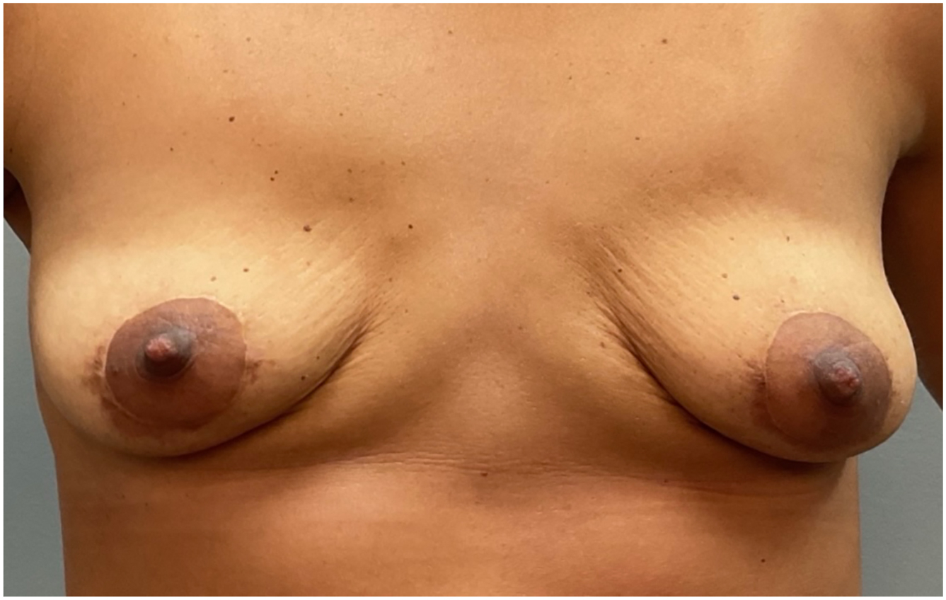 A photograph shows a patient after implant removal, revealing tubular ptotic breasts that have a saggy, tapered appearance. The frontal view shows high inframammary folds and a wide cleavage line.