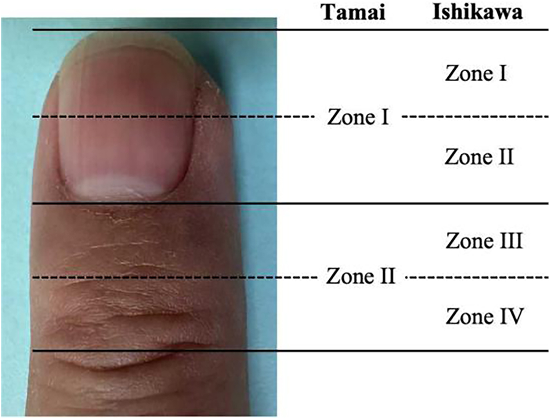 An illustration of a finger showing different zones of classification, with labeled horizontal divisions used to describe injury or surgical levels.