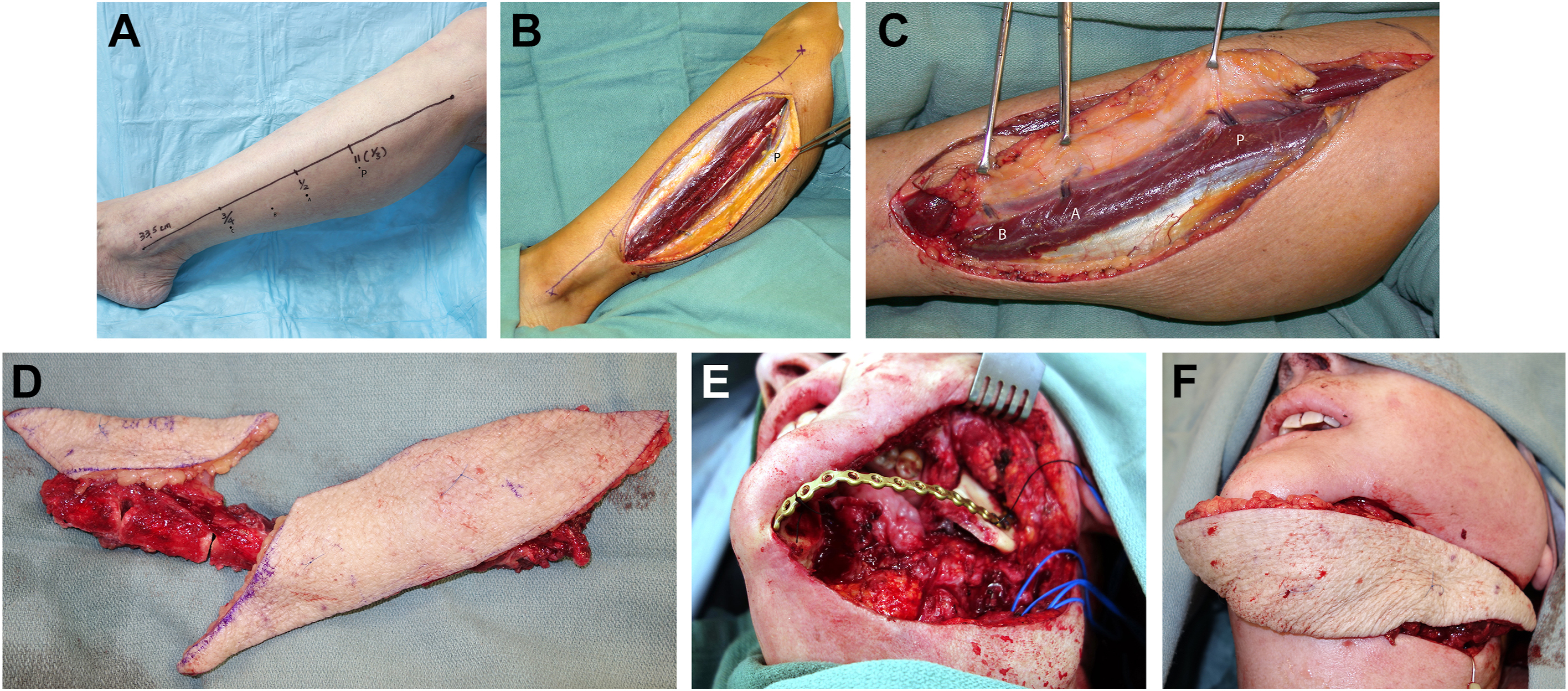 Six surgical photos show fibula flap planning, dissection, harvested skin flaps, and their use for both mouth lining and outer cheek repair.