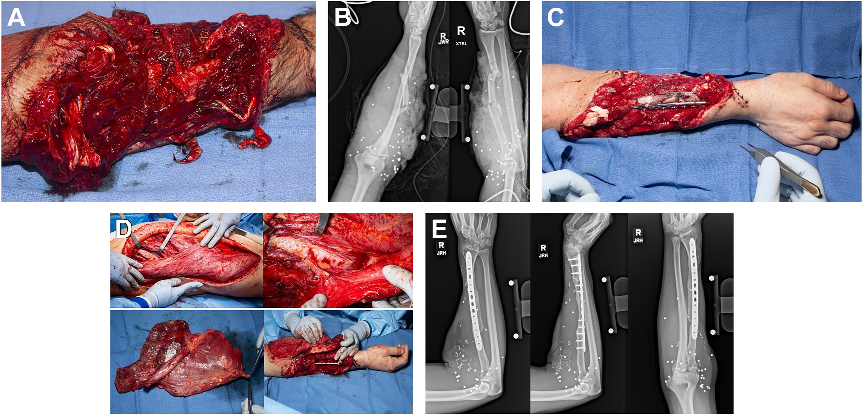 A six-series show traumatic forearm injury, surgical reconstruction with grafts, and radiographs confirming bone healing at one year.