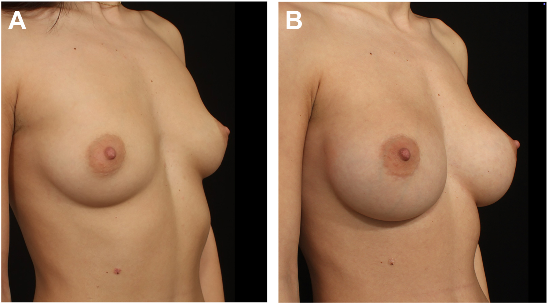 A pair of photographs shows a woman in three quarter views before and after breast augmentation.