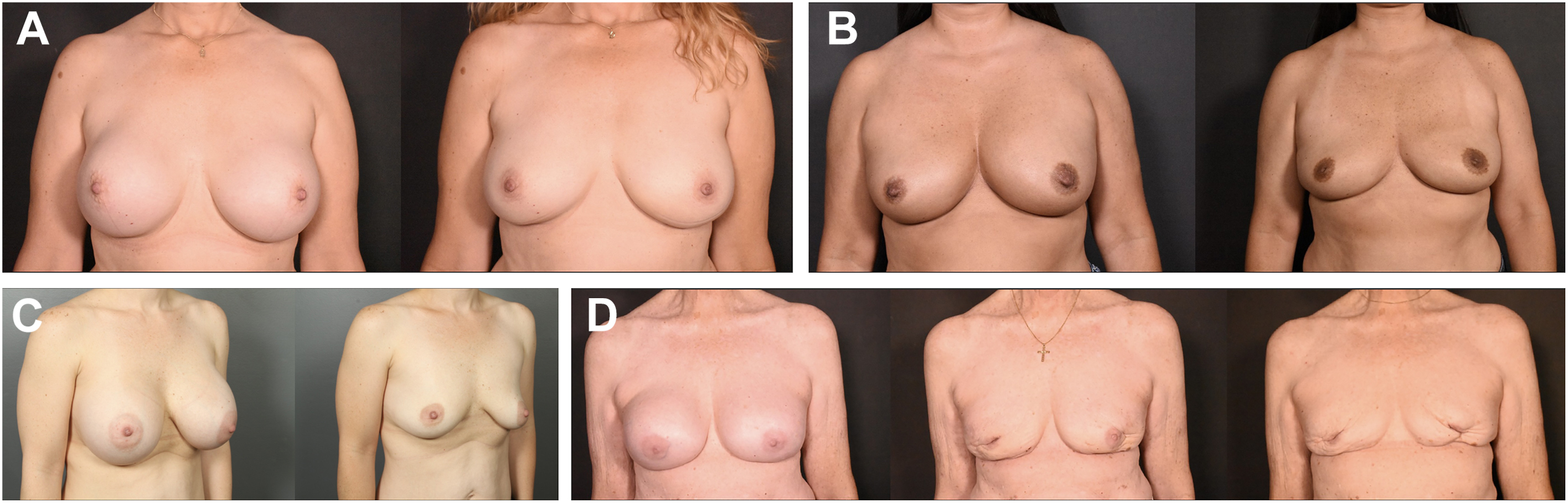 A set of four before and after comparisons shows breast implant removal. The rows compare favorable and unfavorable results based on whether the capsule was removed or left in place.