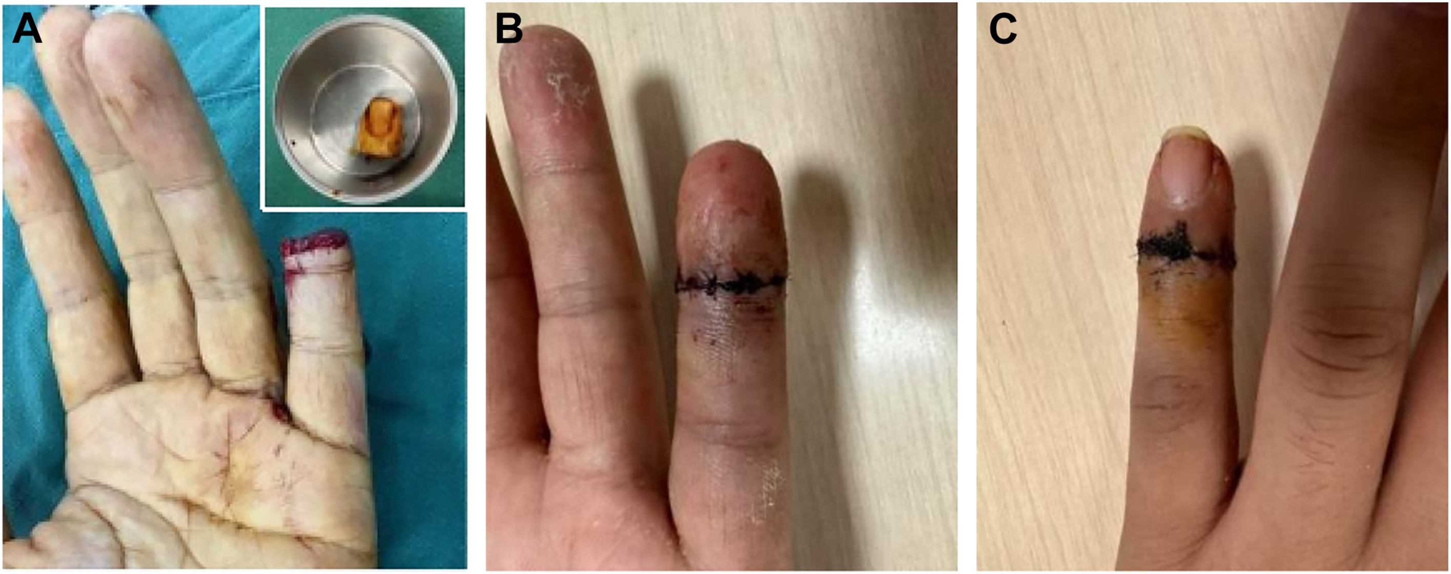 A three-panel medical photo shows a finger injury before and two weeks after replantation surgery.