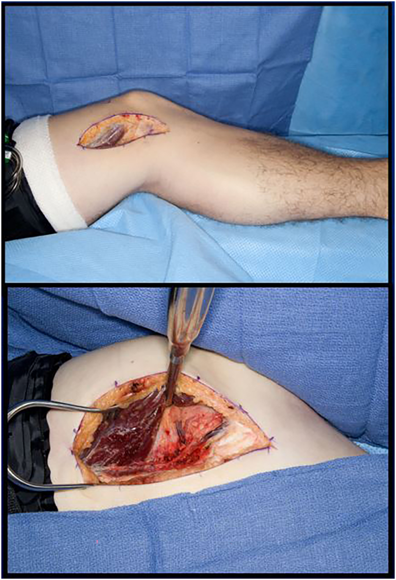 Two surgical photos show a soft tissue defect over the leg and harvesting of a muscle flap from the thigh for reconstruction.