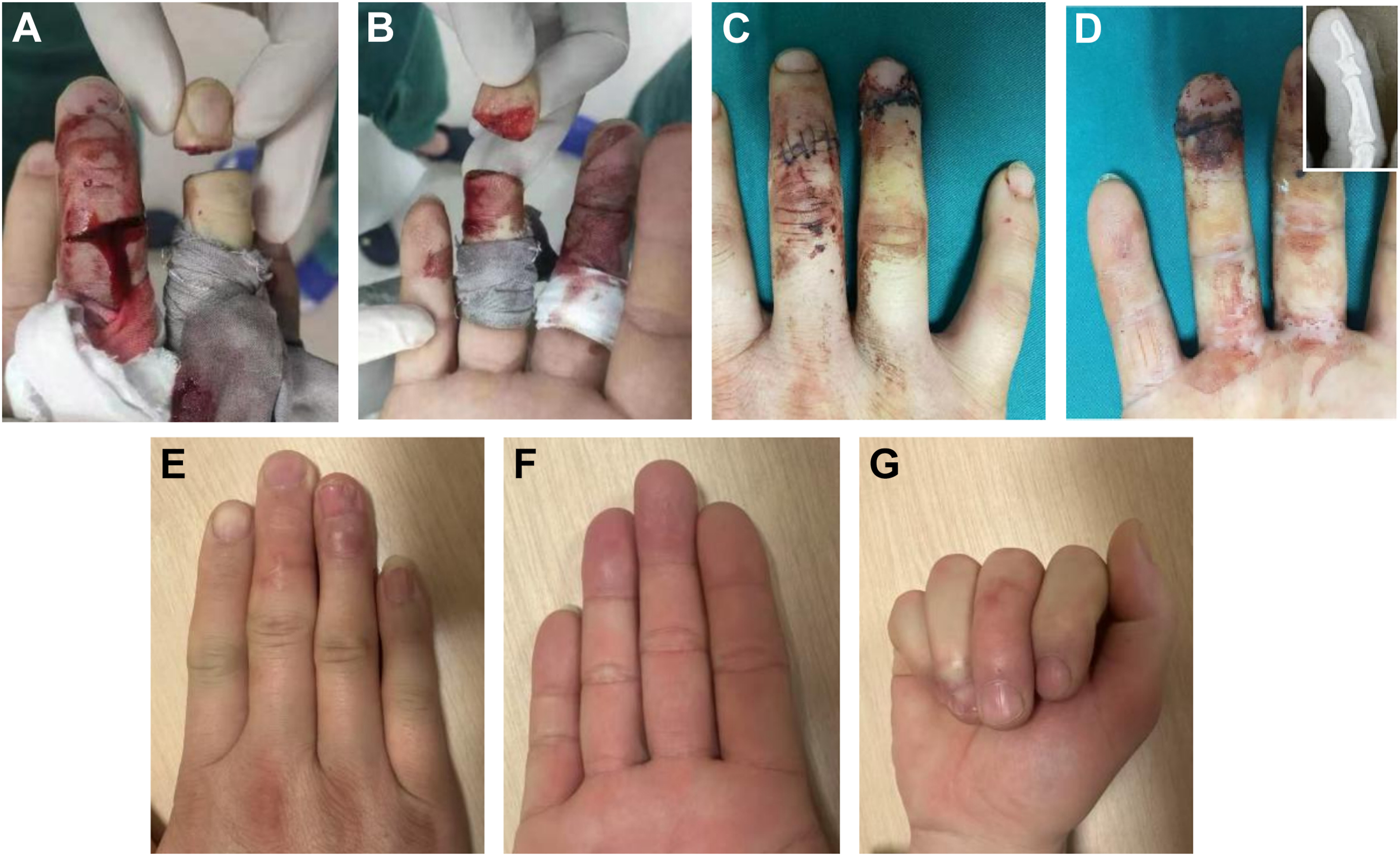 Seven photos show traumatic finger amputation, surgical repair, X-ray confirmation, and later recovery with healed stumps.