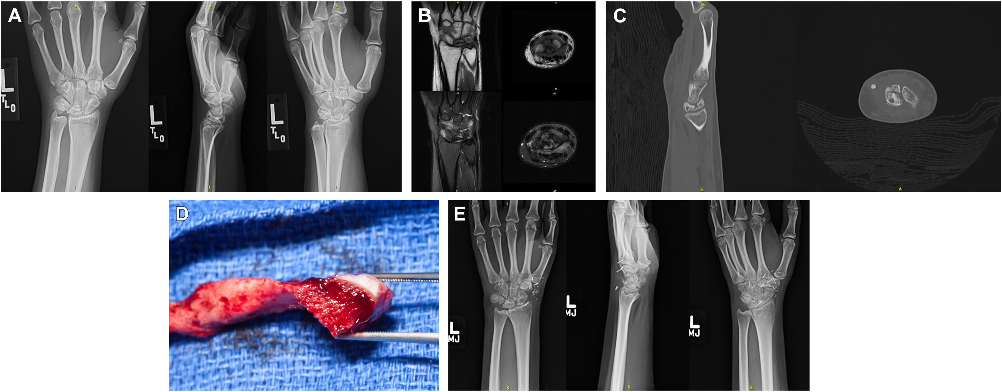 A set of five medical scans and a surgical photo showing bone collapse, grafting with vascularized tissue, and healed lunate on follow-up.